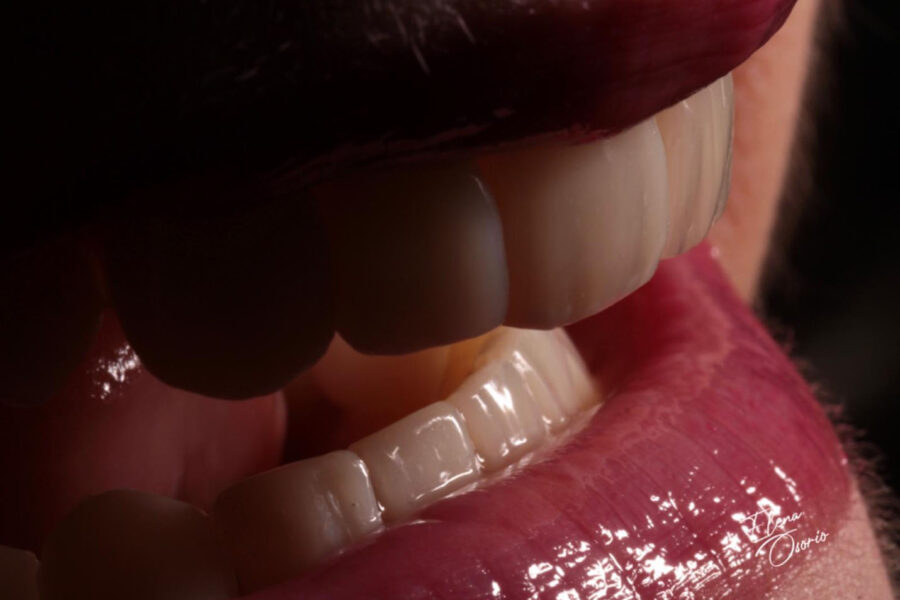 Carillas estéticas en odontología: La solución perfecta para una sonrisa radiante.